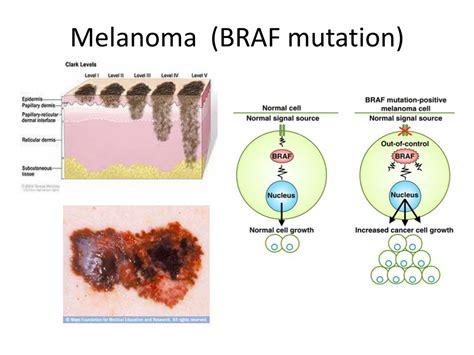 melanoma braf class mutations